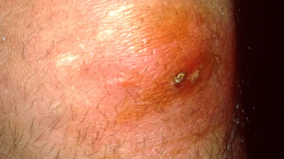 Furúnculo pode matar? Dermatologista alerta sobre riscos