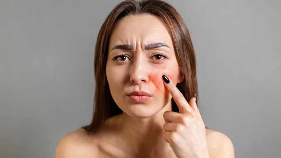 Saiba o que é o eritema infeccioso, conhecido como síndrome da bochecha vermelha