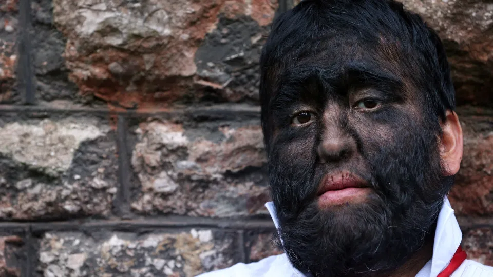 Doenças raras que parecem inventadas, mas são reais